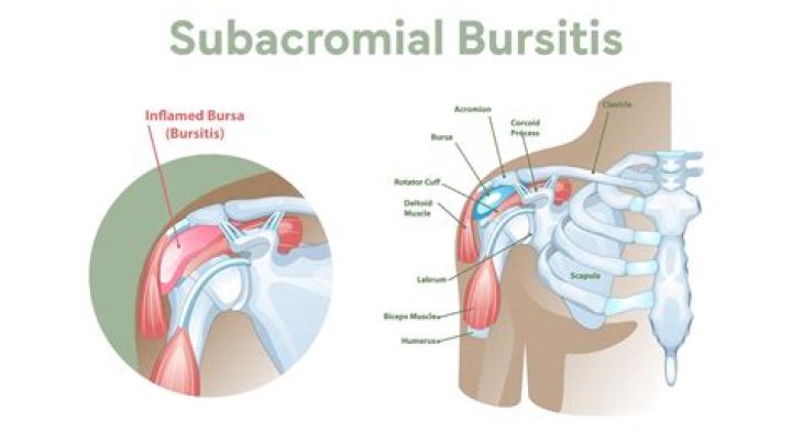 Where is the subacromial subdeltoid bursa?