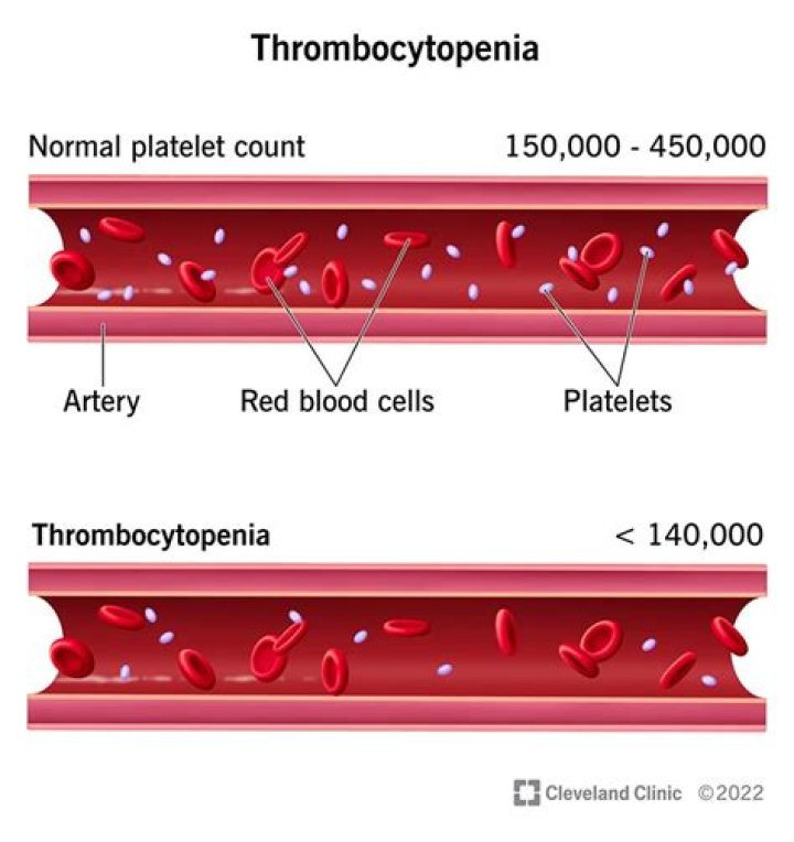 Where is thrombocytopenia made?
