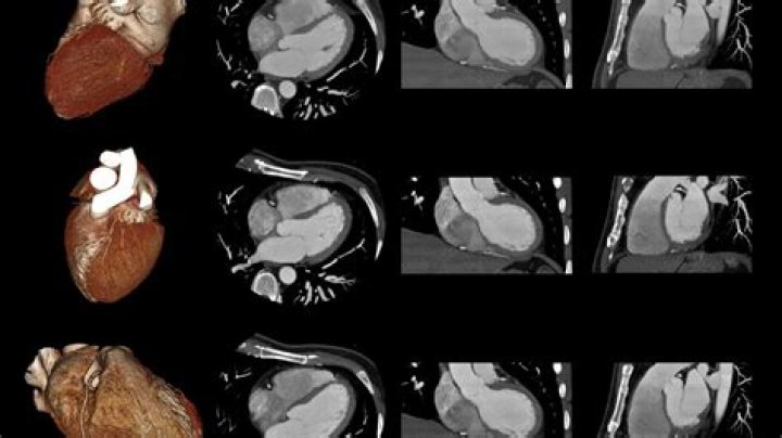 Which angiography is best?
