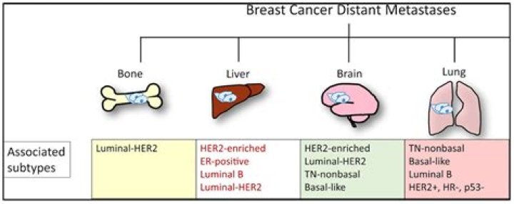 Which cancer is most likely to metastasize?