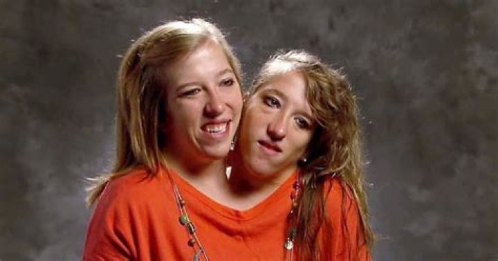 Which conjoined twin controls the body?