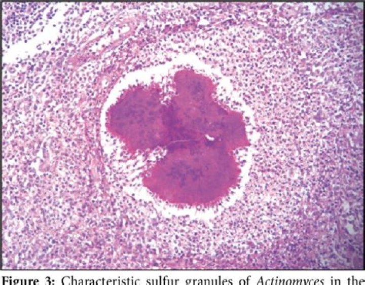 Which doctor treats actinomycosis?
