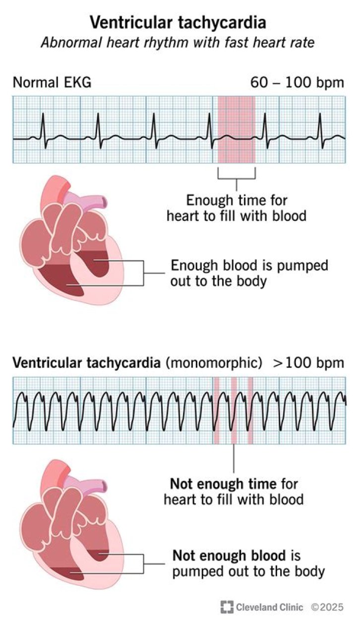 Which electrocardiogram characteristic is consistent with ventricular tachycardia?