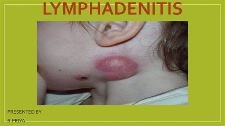 Which is reactive lymphadenitis?