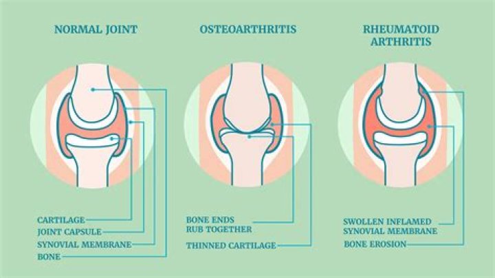 Which joints are affected by psoriatic arthritis?