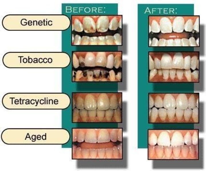 Which of the following drugs can discolor teeth?