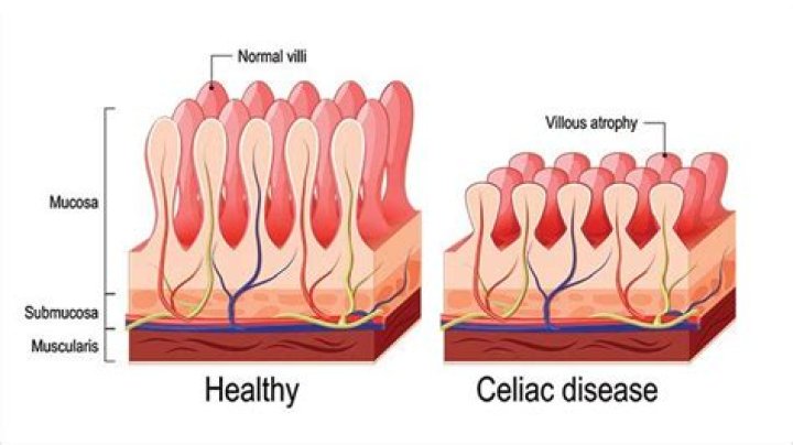 Which organ does celiac disease affect?