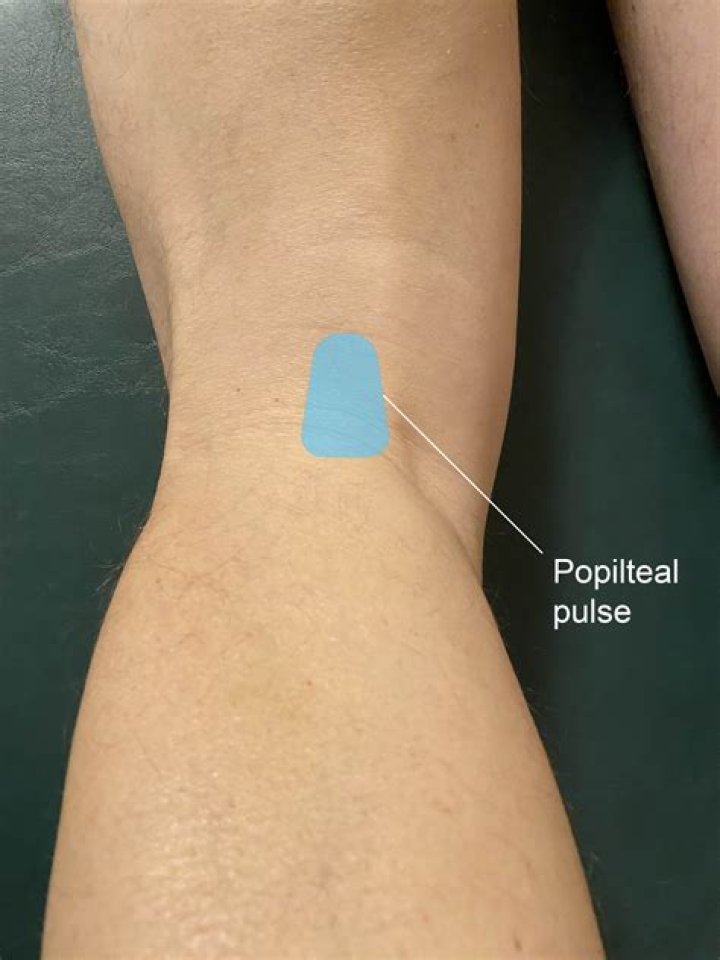 Which site is appropriate for palpation of the popliteal pulse?