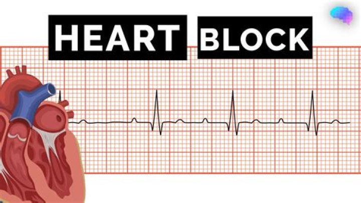 Which test shows blockage in heart?