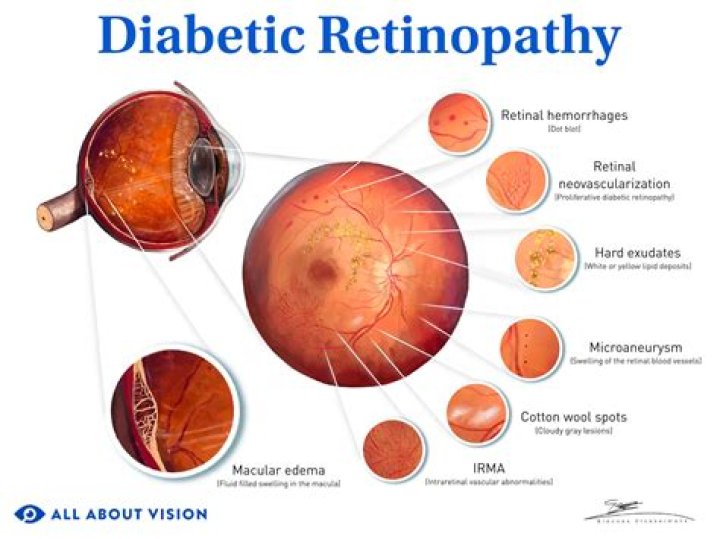 Which type of retinopathy occurs in diabetes mellitus?