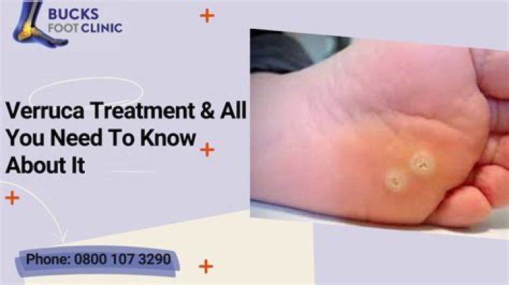 Who can get rid of a verruca?