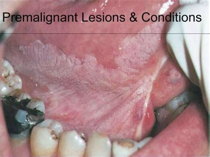 Who classification oral premalignant lesions?