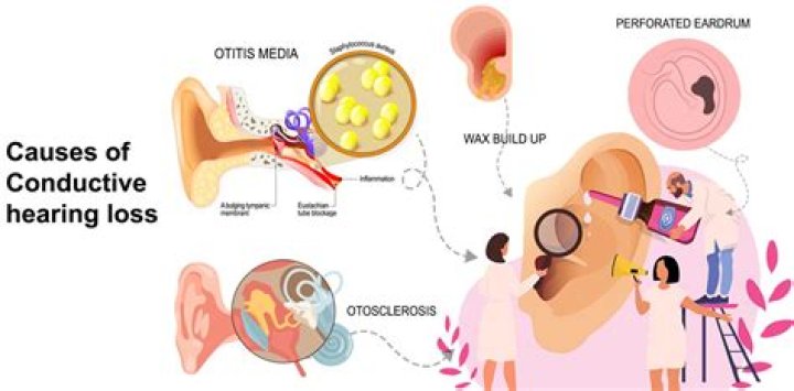 Who conductive hearing loss definition?