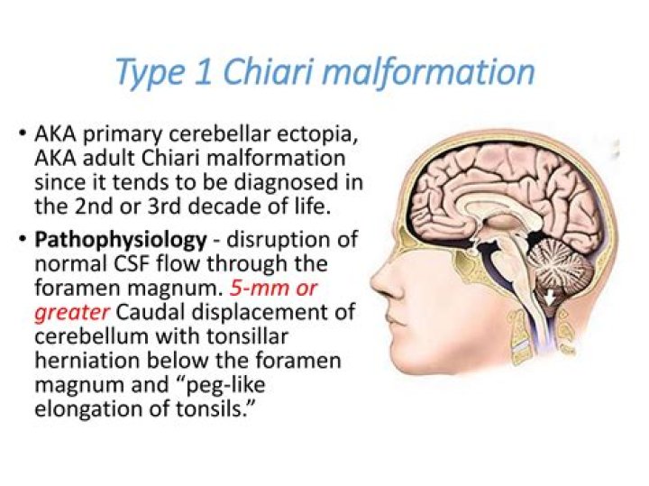 Who diagnoses chiari malformation?