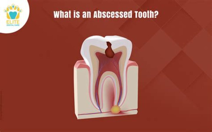 Who do you see for an abscessed tooth?