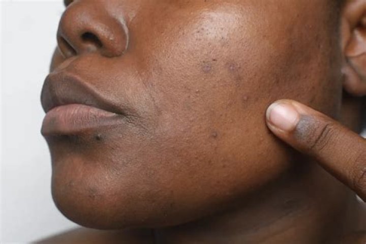 Who does blemish mean?