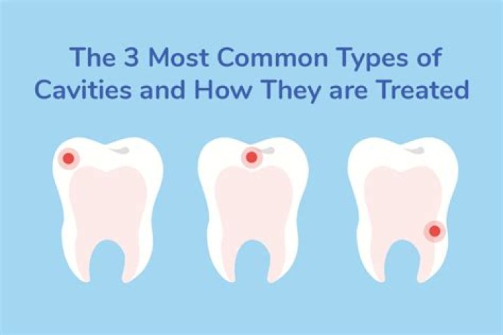 Who does cavities affect the most?