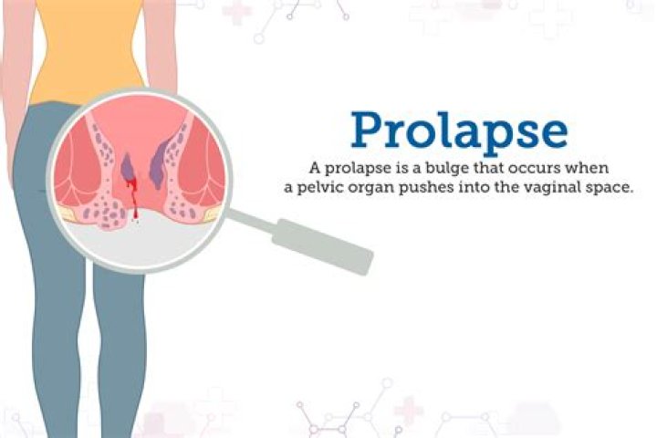 Who does prolapse surgery?