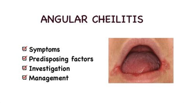 Who gets angular cheilitis?