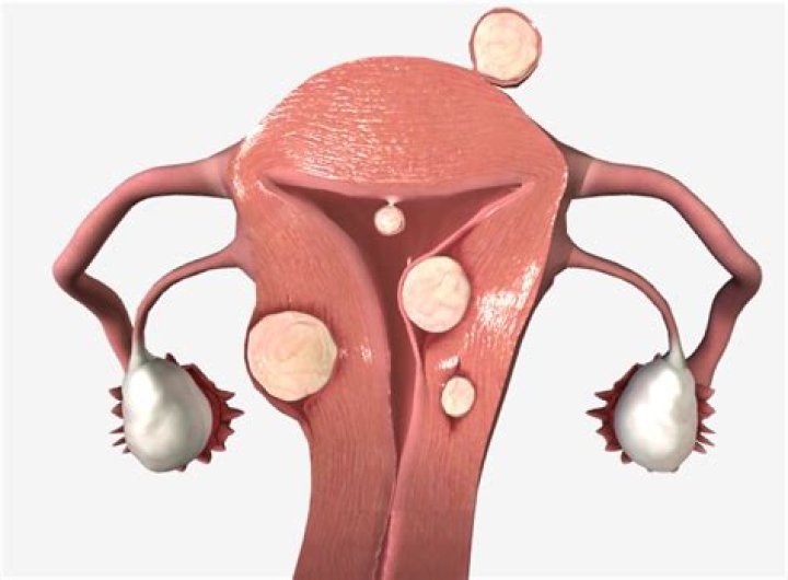 Who gets uterine leiomyomas?