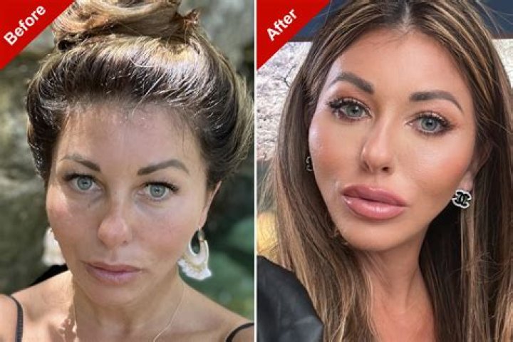 Who has had the most facelifts?