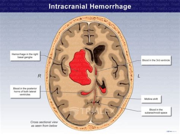 Who intracranial hemorrhage definition?