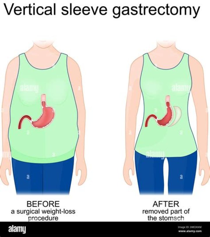Who invented sleeve gastrectomy?