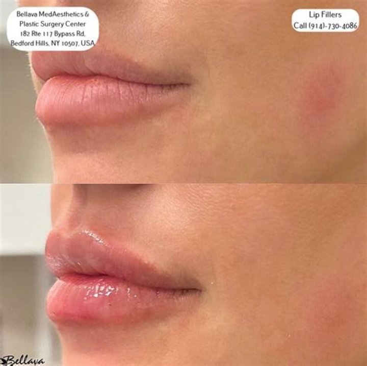 Who is lip lacquer?