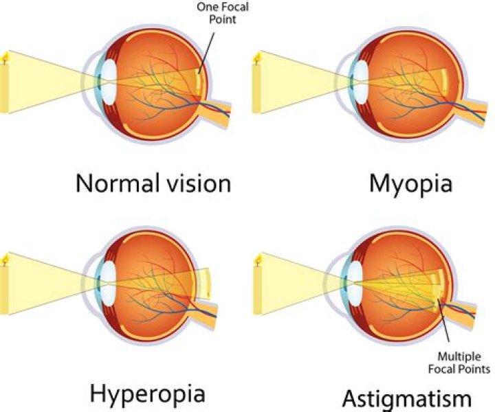 Who is prone to hyperopia?