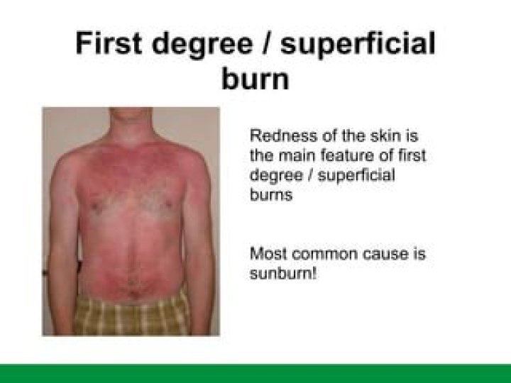 Who is superficial burn?