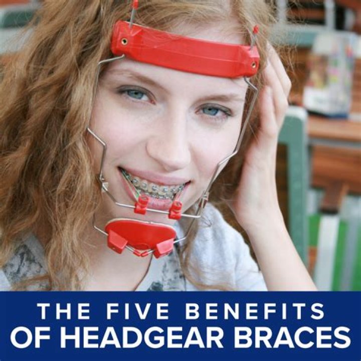 Who needs headgear with braces?
