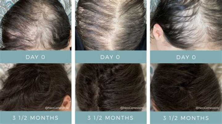 Who to regrow hair?