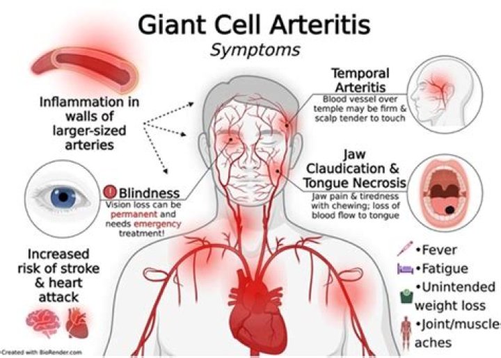 Who treats carotid stenosis?
