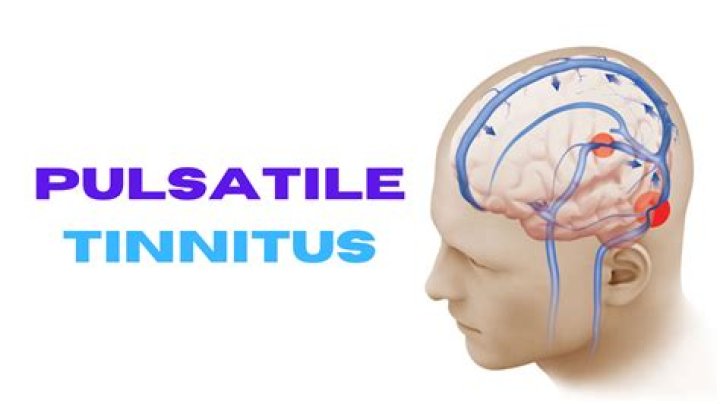 Who treats pulsatile tinnitus?
