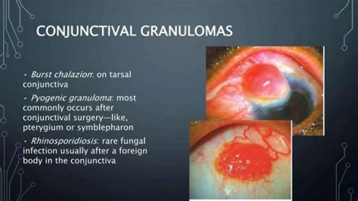 Why anemia seen in lower palpebral conjunctiva?