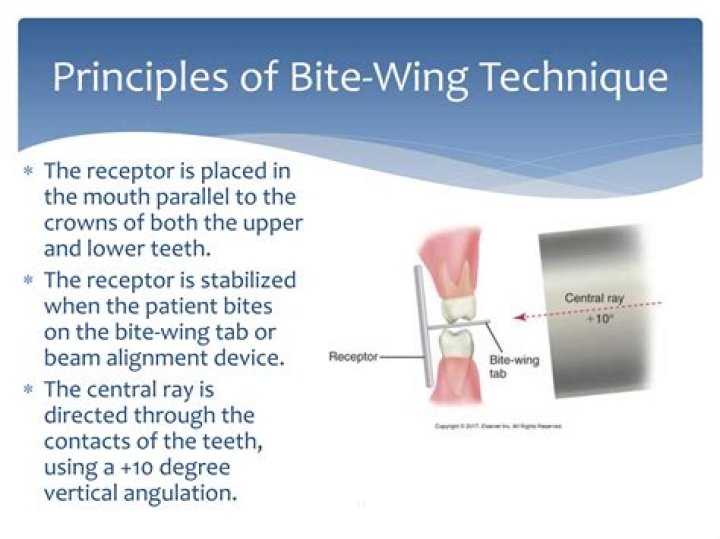Why are bitewings taken?