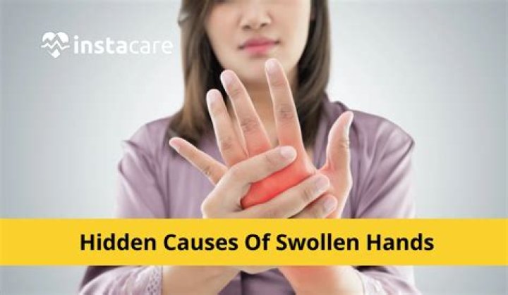 Why are my hands swollen and red?