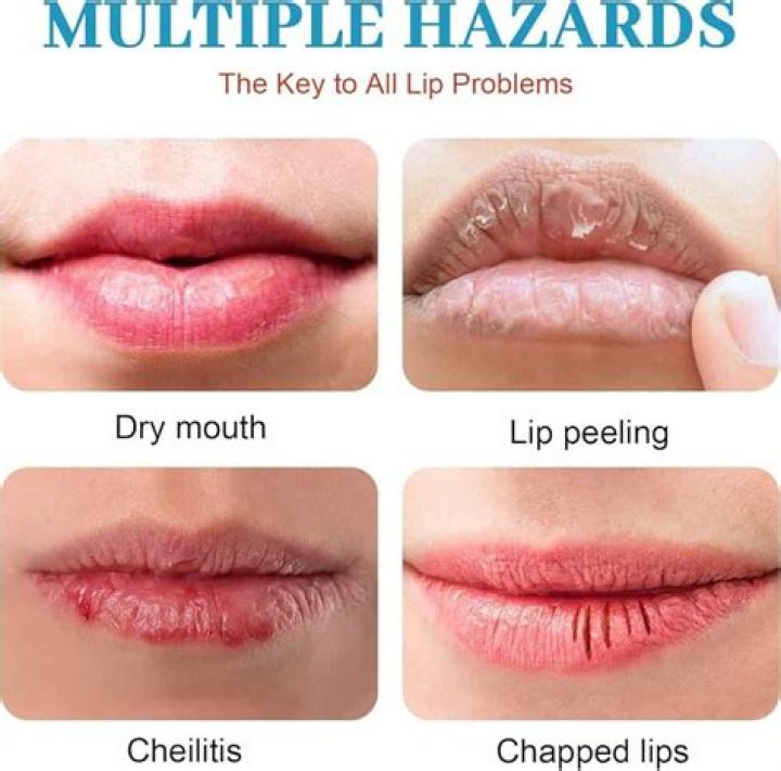 Why are my lips so chapped?