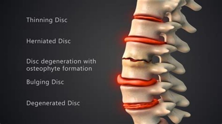 Why degenerative disc disease occurs?