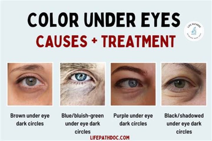 Why discoloration around eyes?