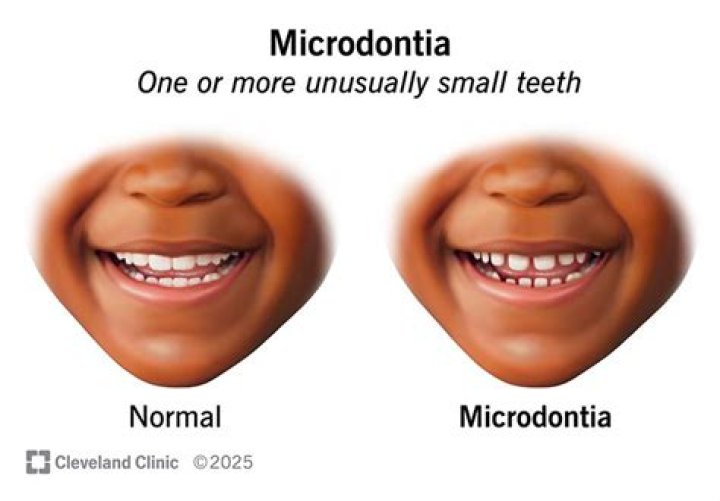 Why do i have macrodontia?