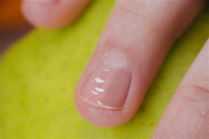 Why do i have white tipped nails?