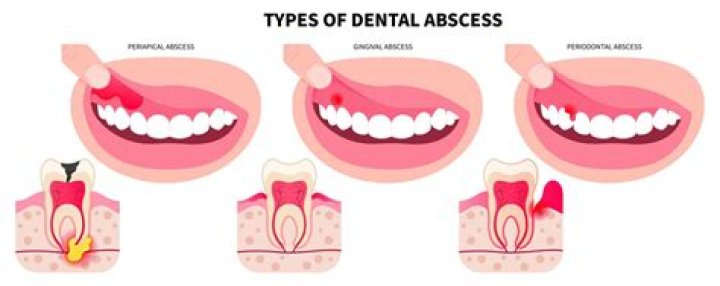 Why do my teeth keep abscessing?