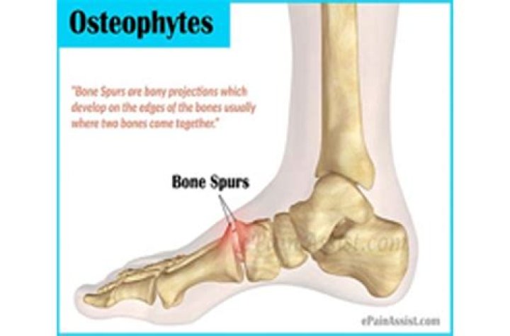 Why do osteophytes form?