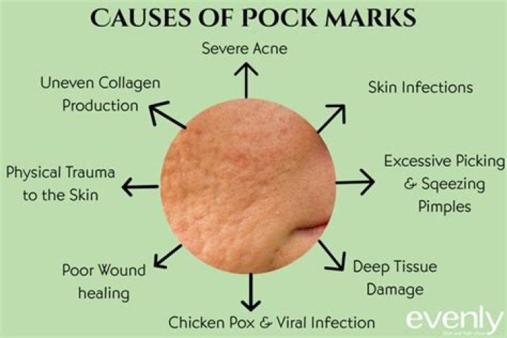 Why do pockmarks occur?