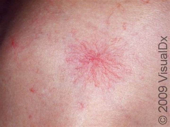 Why do spider angiomas occur?