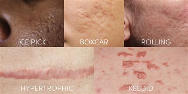 Why do you get scars?