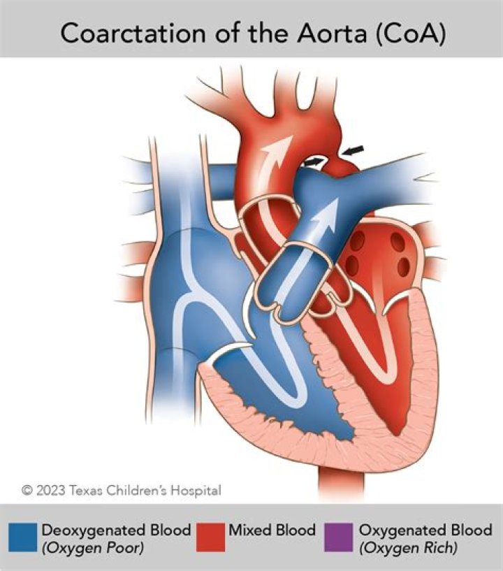 Why does coarctation of aorta cause hypertension?