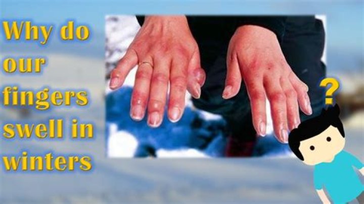 Why fingers swell in winter?