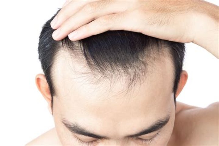 Why has my hair thinned over the years?